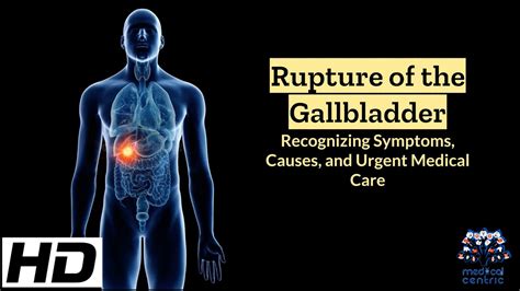 b4il3e leaks|Rupture of Gallbladder: Causes, Symptoms & Diagnosis